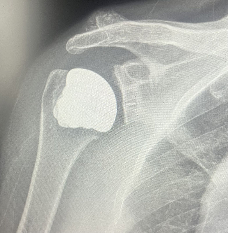Total Shoulder Replacement Post-Op X-Ray