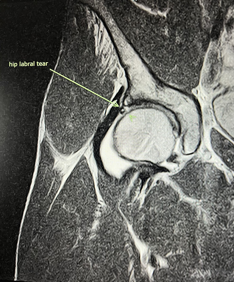 Hip Labral Tear - Hip MRI