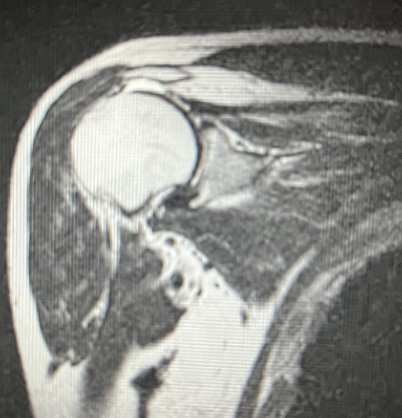 Anterior cruciate ligament tear - knee MRI