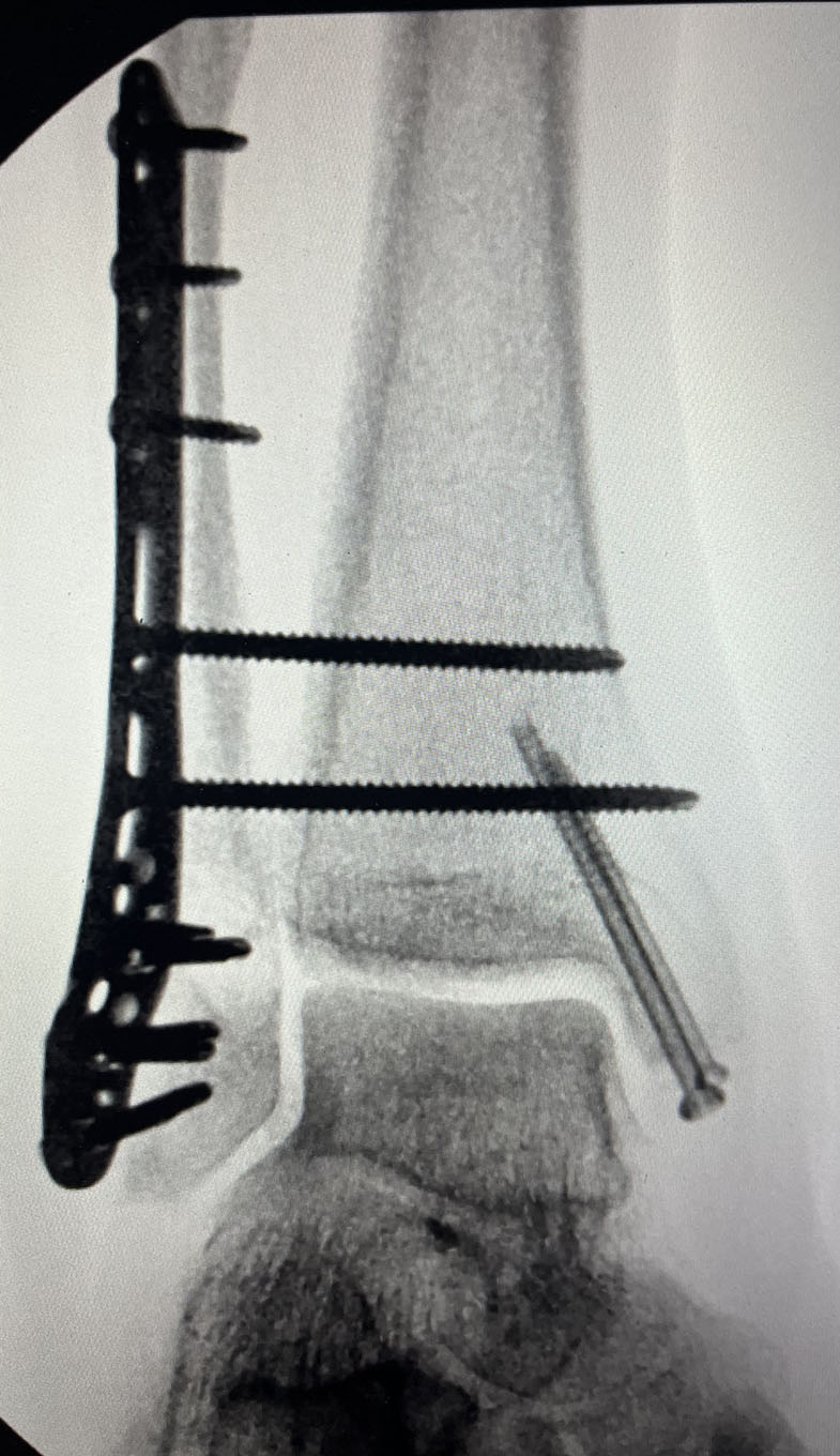 Ankle Fracture - Post-op ORIF