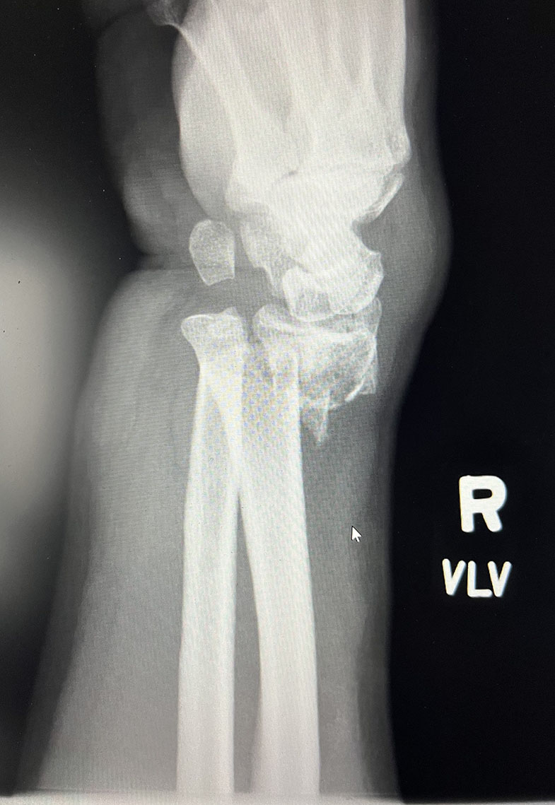 Wrist Fracture - preop