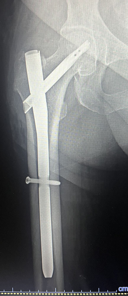 Hip fracture -post op TFNA