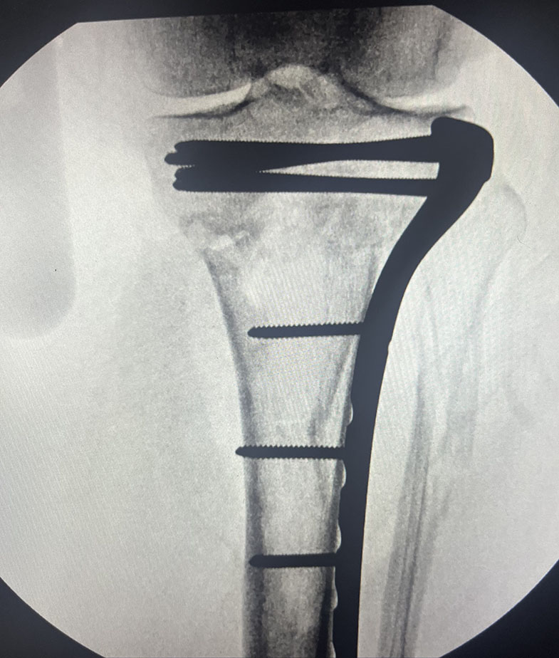 Knee tibial plateau fracture - post op ORIF