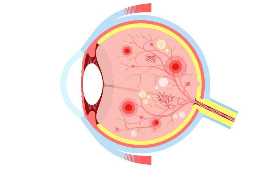 Diabetic Retinopathy