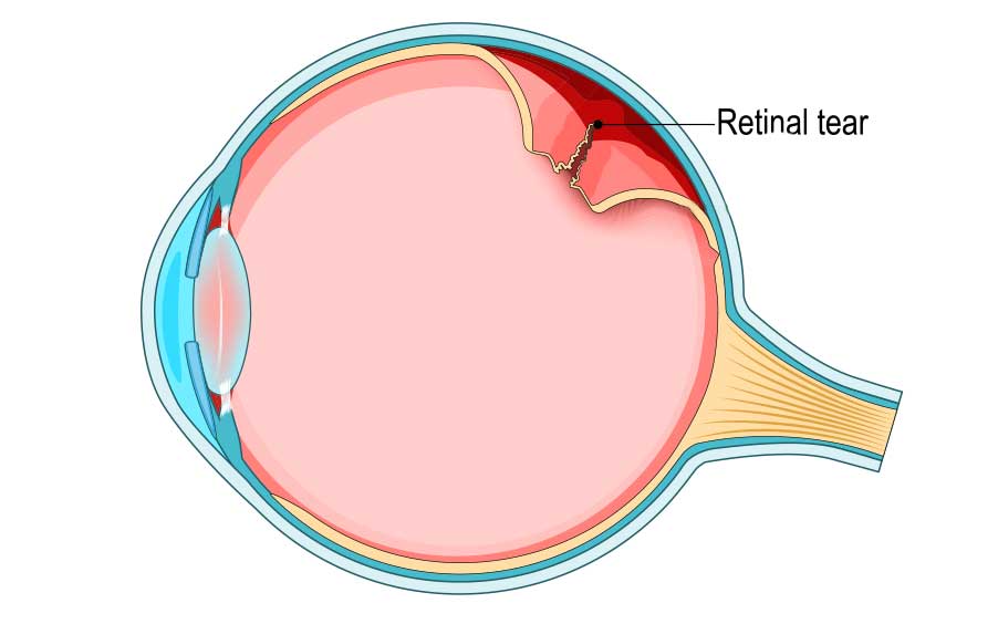Retinal Tears