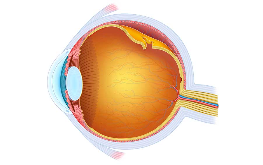 Retinal Detachment