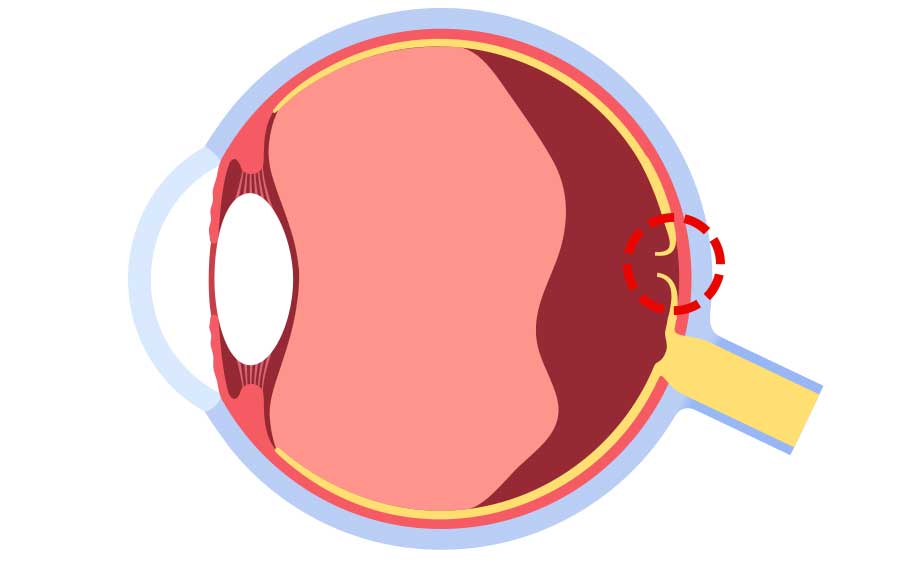 Macular Holes