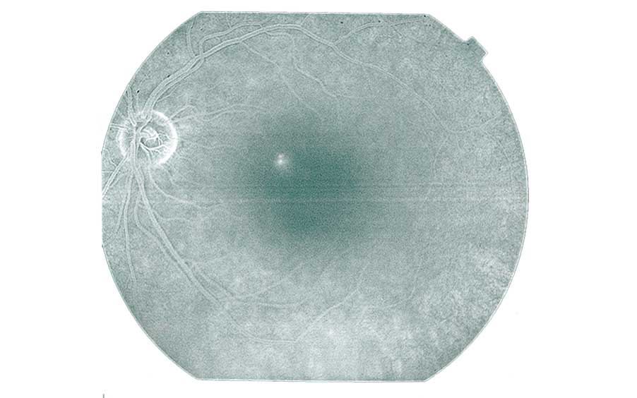 Central Serous Chorioretinopathy