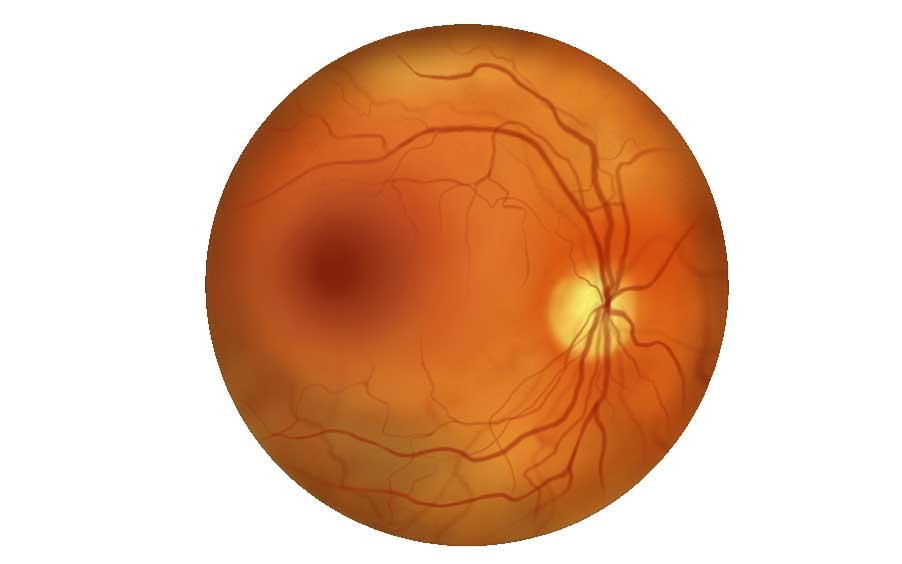 Retinal Vein Occlusion