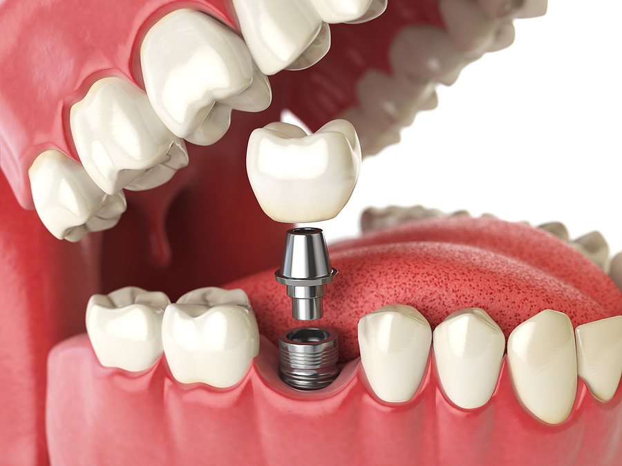 Homecare after Dental Implants have been placed