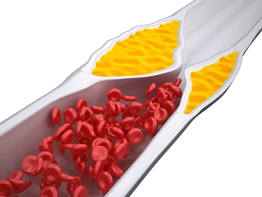 Coronary Calcium Scoring