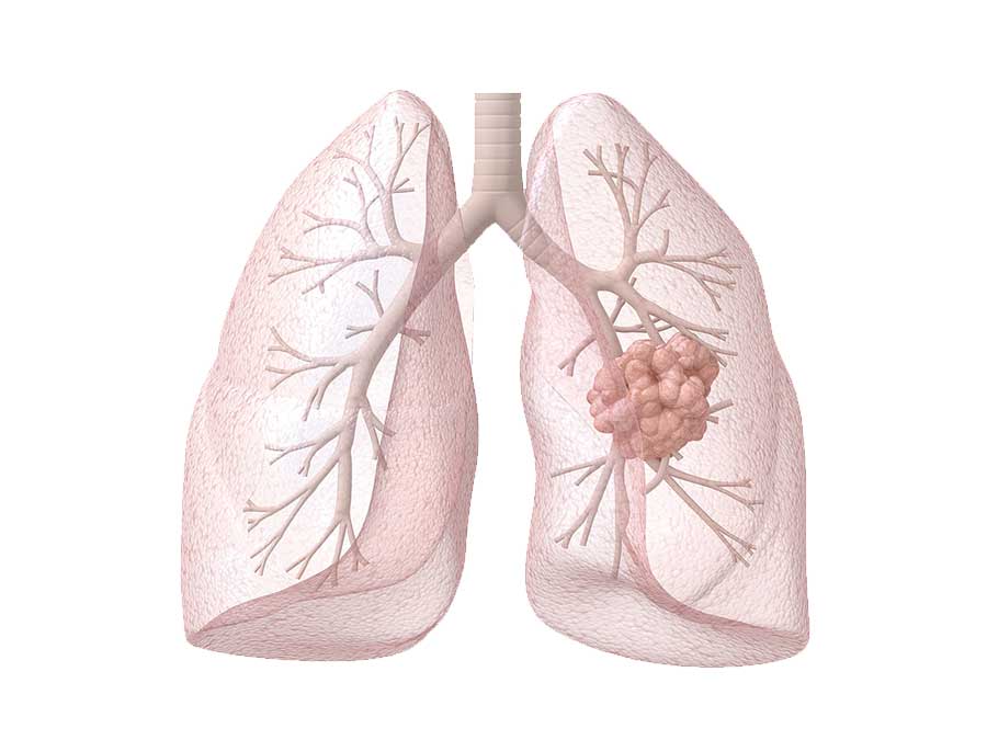 Lung Cancer Screening
